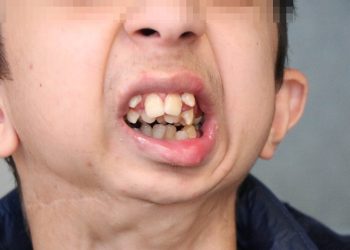 Samsun’da kemik problemleri yaşıyor! Alt çenesi yok…